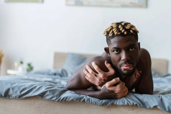Musculoso afroamericano hombre con vitiligo mirando a la cámara mientras está acostado en la cama - foto de stock
