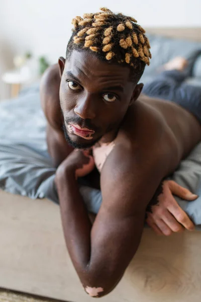 Retrato de hombre afroamericano sin camisa con vitiligo acostado en la cama por la mañana - foto de stock