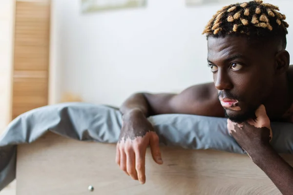 Shirtloser afrikanisch-amerikanischer Mann mit Vitiligo schaut weg, während er auf dem Bett liegt — Stockfoto