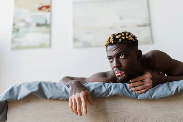 Jovem afro-americano com vitiligo deitado na cama em casa — Fotografia de Stock