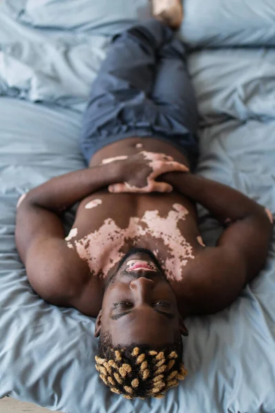 High angle view of apathetic african american man with vitiligo lying on bed at home — Stock Photo