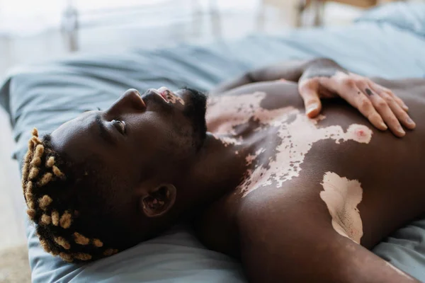 Shirtless african american man with vitiligo resting on bed at home — Stock Photo