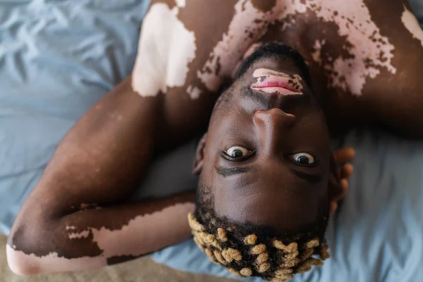Top view of shirtless african american man with vitiligo looking at camera on bed — Stock Photo