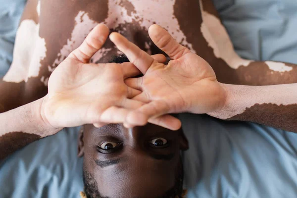 Draufsicht auf hemdslosen afrikanisch-amerikanischen Mann mit Vitiligo bedecken Gesicht auf dem Bett — Stockfoto