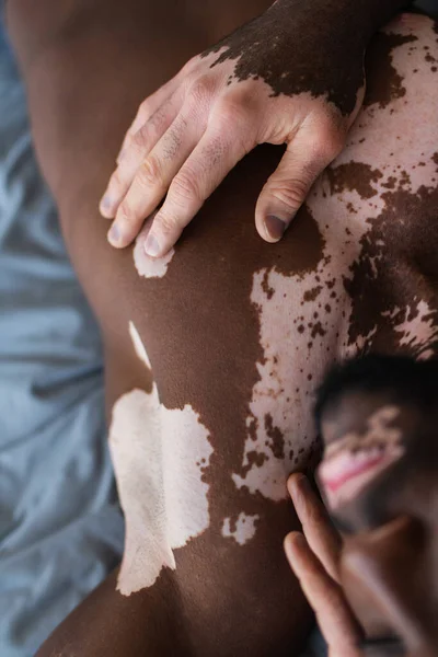 Vista recortada del hombre afroamericano sin camisa con vitiligo tocando la piel en la cama - foto de stock