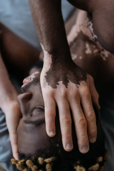 Vista superior de joven afroamericano hombre con vitiligo tocando la cara mientras está acostado en la cama - foto de stock