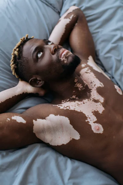 Високий кут зору безсоромного африканського чоловіка з вітиліго лежить на ліжку. — стокове фото