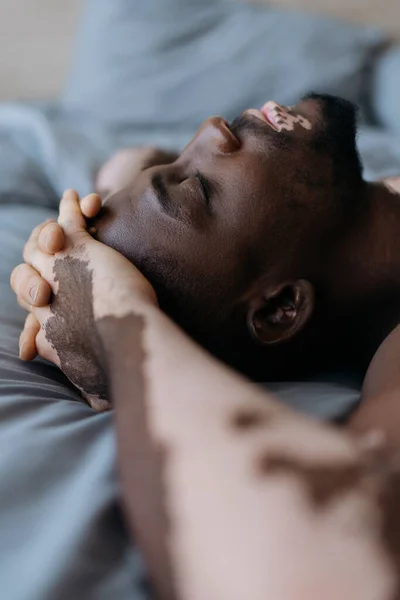 Vista lateral del hombre afroamericano con vitiligo descansando en la cama en casa - foto de stock