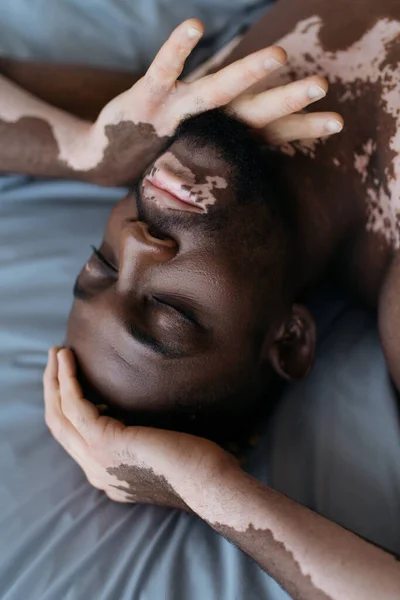 Vista dall'alto dell'uomo afroamericano senza maglietta con vitiligine appoggiata sul letto — Foto stock