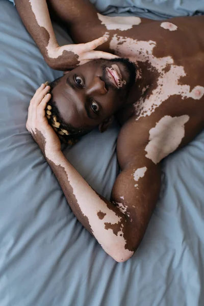 Visão superior do homem americano africano muscular com vitiligo olhando para a câmera enquanto deitado na cama — Fotografia de Stock