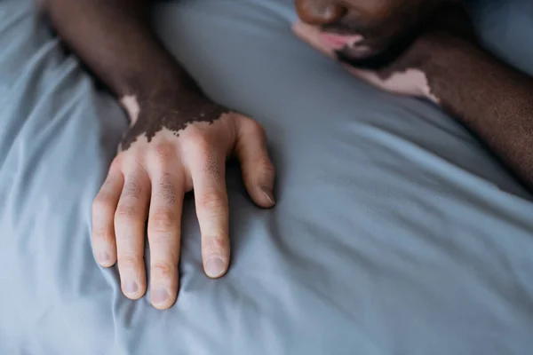 Vista cortada do homem americano africano com vitiligo deitado na cama de manhã — Fotografia de Stock