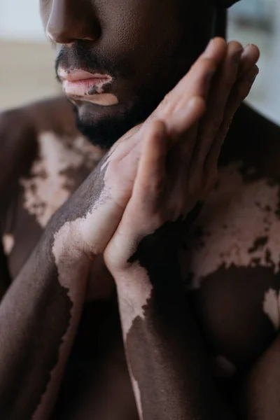 Vista recortada del hombre afroamericano sin camisa con vitiligo de pie con las manos dobladas en casa - foto de stock