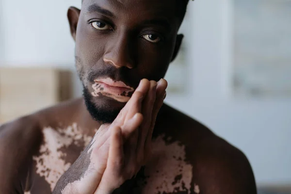 Portrait of shirtless african american man with vitiligo looking at camera at home — Stock Photo