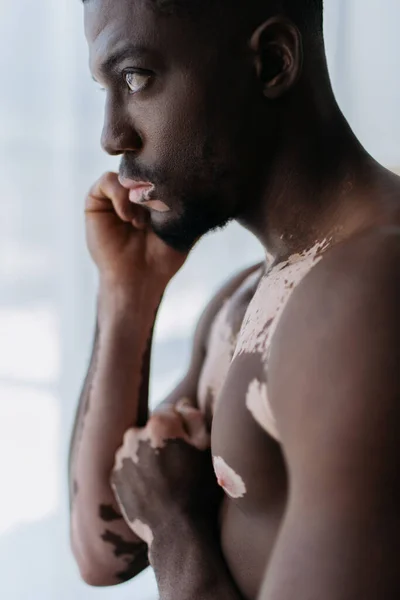 Seitenansicht eines hemdslosen afrikanisch-amerikanischen Mannes mit Vitiligo, der zu Hause steht — Stockfoto
