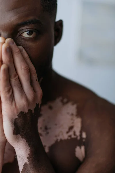 Vue recadrée de l'homme afro-américain torse nu avec vitiligo couvrant le visage à la maison — Photo de stock