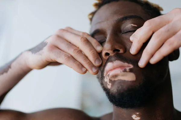 Portrait de jeune homme afro-américain avec vitiligo toucher le visage à la maison — Photo de stock