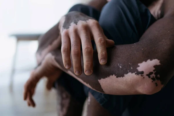 Ausgeschnittene Ansicht von afrikanisch-amerikanischen Mann mit Vitiligo zu Hause — Stockfoto