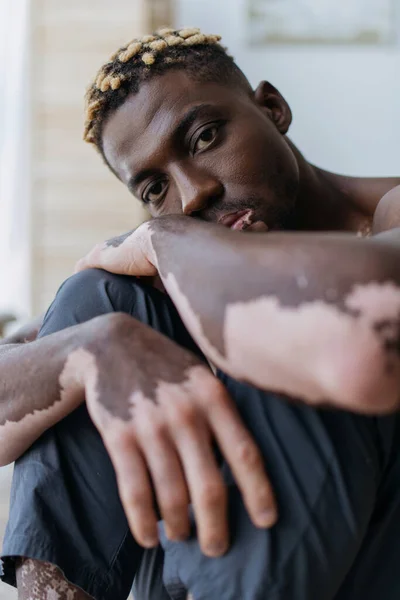 Retrato de un joven afroamericano con vitiligo mirando a la cámara en casa - foto de stock