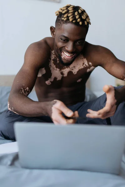Homme américain africain gai et torse nu avec vitiligo ayant chat vidéo sur ordinateur portable sur le lit — Photo de stock