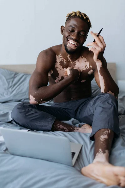 Positive and shirtless african american man with vitiligo holding pen near laptop on bed — Stock Photo