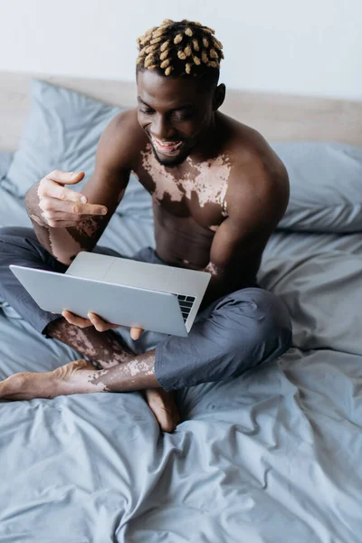 Sonriente y sin camisa hombre afroamericano con vitiligo tener videollamada en el ordenador portátil en la cama - foto de stock