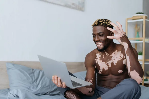 Spensierato uomo africano americano con vitiligine avere video chat sul computer portatile in camera da letto — Foto stock