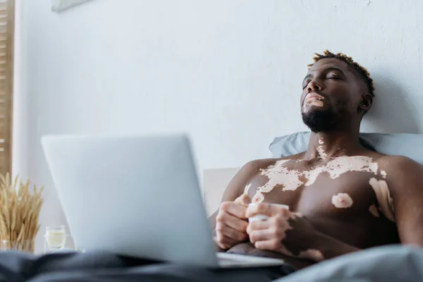 Cansado afroamericano hombre con vitiligo celebración de café cerca de la computadora portátil en la cama - foto de stock