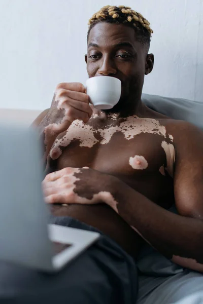 Африканский мужчина без рубашки с витилиго держит кофе и ноутбук в спальне — стоковое фото