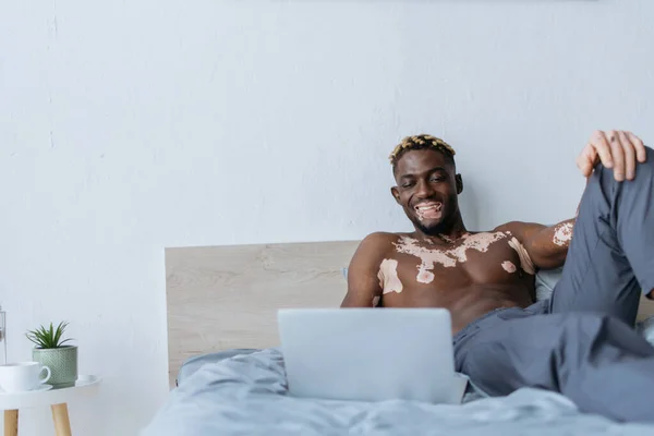 Sorrindo homem americano africano com vitiligo olhando para laptop na cama em casa — Fotografia de Stock