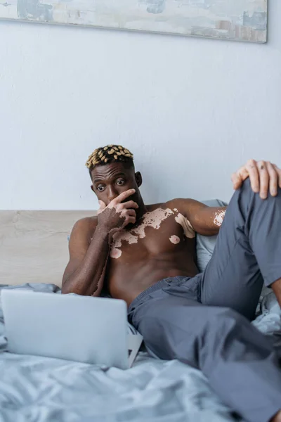 Homem afro-americano chocado com vitiligo olhando para laptop na cama — Fotografia de Stock