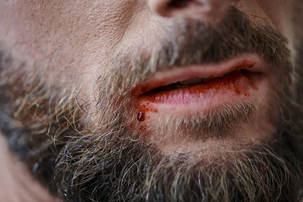Vista recortada del hombre ansioso con barba mordiéndose los labios hasta la sangre durante el episodio depresivo - foto de stock
