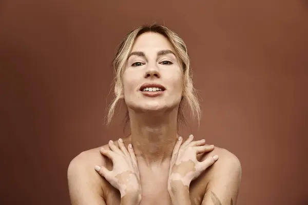 Una giovane donna con la vitiligine posa con fiducia con le spalle nude su uno sfondo beige. — Foto stock