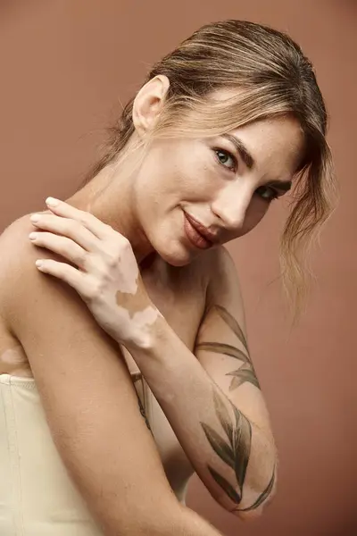 A young woman with vitiligo poses with bare shoulders, showcasing her unique beauty and confidence. — Stock Photo