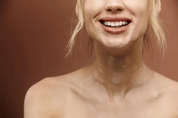Close-up photo of a young woman with vitiligo smiling against a beige background. — Stock Photo