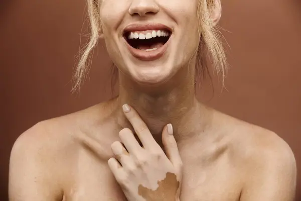 Une femme au vitiligo sourit vivement avec les épaules nues sur un fond beige. — Photo de stock