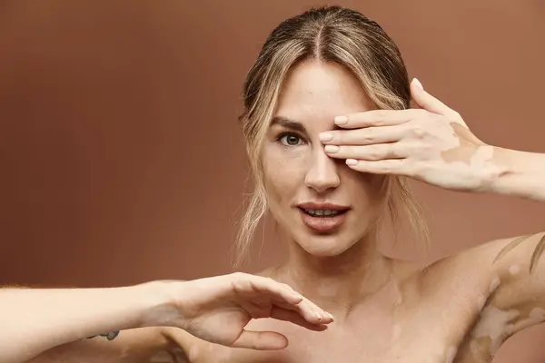 A young woman with vitiligo and a tattoo poses with her shoulders bare against a beige backdrop. Her confidence and beauty shine through. — Stock Photo