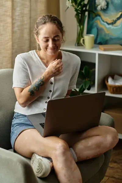 A woman with vitiligo smiles while engaging with her laptop in a cozy living space. — Stock Photo