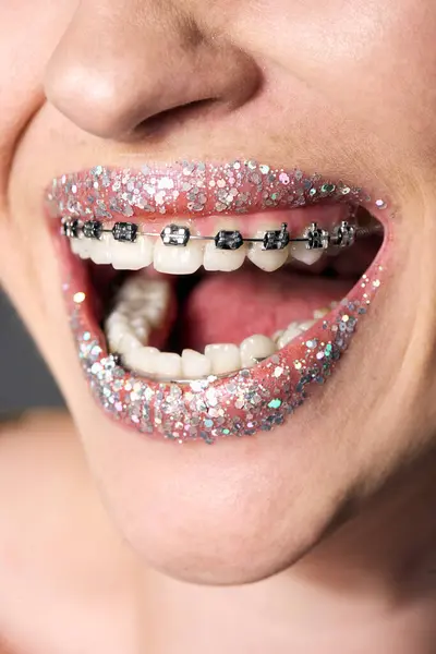 A joyful young woman displays her glittery lips and braces, radiating happiness in the moment. — Stock Photo