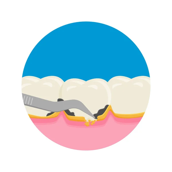 Escala Dentes Remoção Placas Dentárias Para Limpeza Saúde — Vetor de Stock