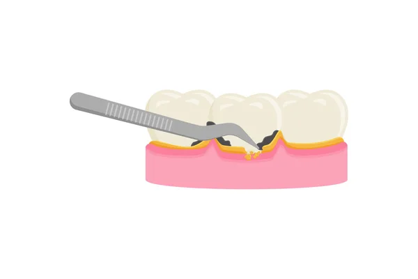 Масштабування Зубів Видалення Зубного Нальоту Очищення Здоров — стоковий вектор