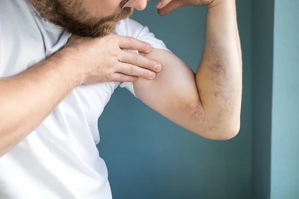 Seorang Pria Memeriksa Memar Besar Lengannya Yang Disebabkan Oleh Cedera — Stok Foto