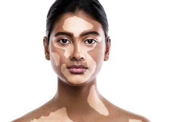 Beyaz arka planda vitiligo deri bozukluğu olan güzel Güney Asyalı kadın portresi