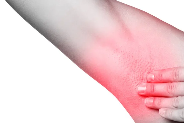 Closeup Female Armpit Redness Skin Irritation Swollen Lymph Node — Stock Photo, Image