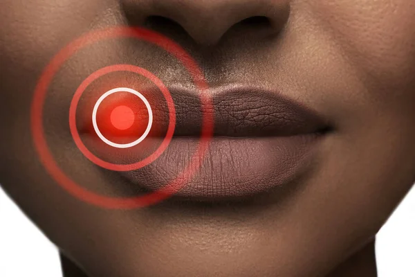Closeup Black Woman Lips Affected Herpes Simplex Virus — Stock Photo, Image