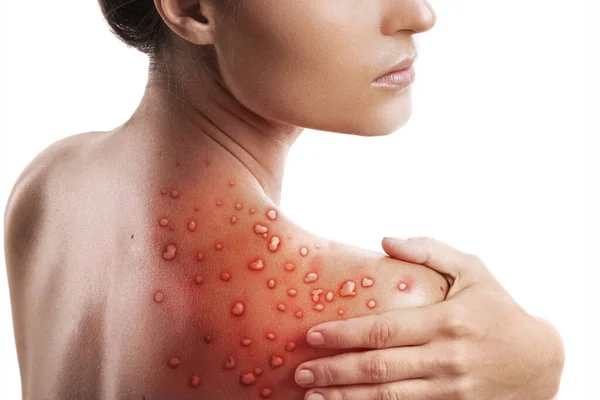 Woman Her Skin Affected Blistering Rash Because Monkeypox White Background — Stock Photo, Image