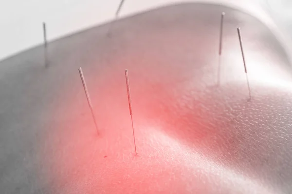 Alternativ Medicin Närbild Kvinnlig Kropp Med Inlagda Stålnålar Akupunkturbehandlingen — Stockfoto