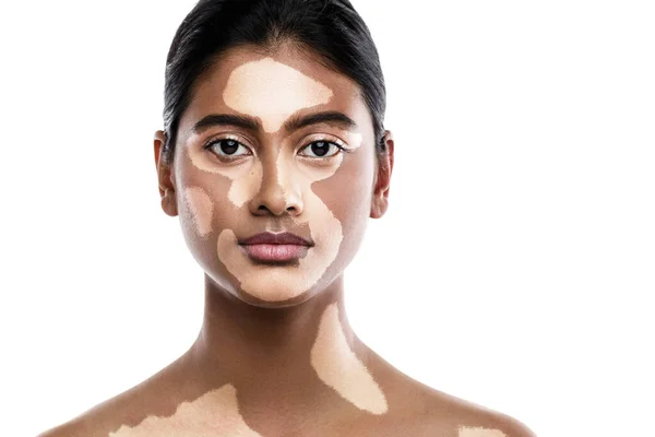 Portrait Belle Femme Sud Asiatique Avec Trouble Peau Vitiligo Sur — Photo