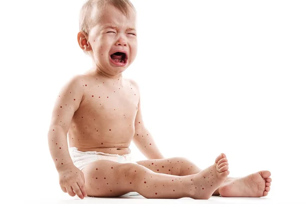 Baby Boy Skin Affected Blistering Rash Because Monkeypox Chickenpox White — Stock Photo, Image