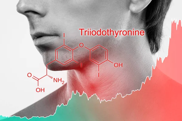 甲状腺によって産生されるトリヨードチロニンホルモンの上昇の男性の首とチャート — ストック写真