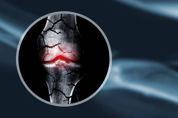 Рентгеновское Изображение Сломанными Костями Концепция Остеопороза Патологических Переломов — стоковое фото